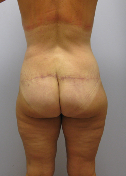 Thigh Lift Before & After Image