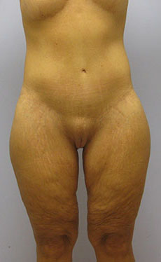 Thigh Lift Before & After Image