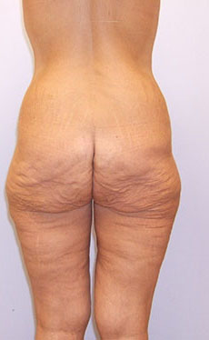 Thigh Lift Before & After Image