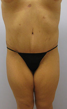 Thigh Lift Before & After Image