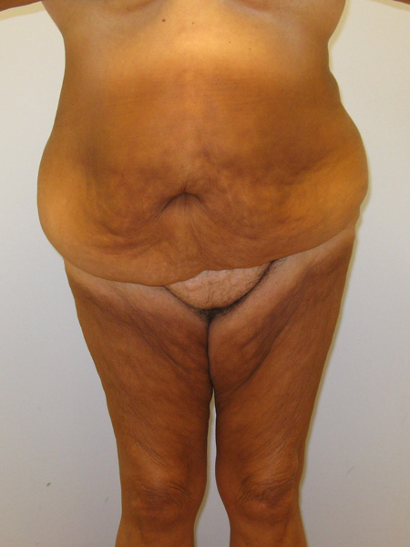 Thigh Lift Before & After Image