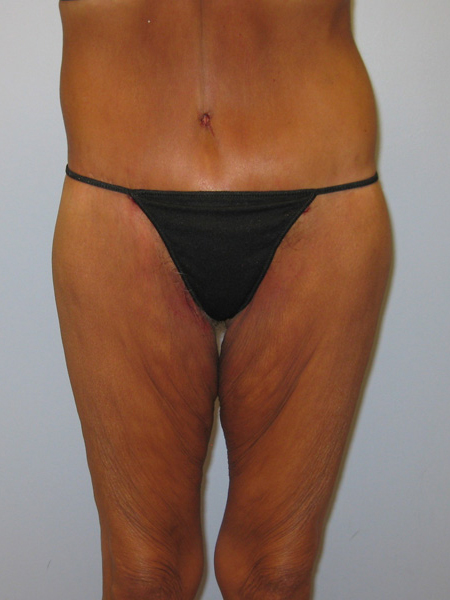 Thigh Lift Before & After Image