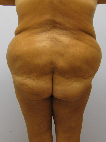 Thigh Lift Before & After Image