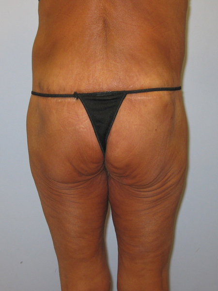 Thigh Lift Before & After Image