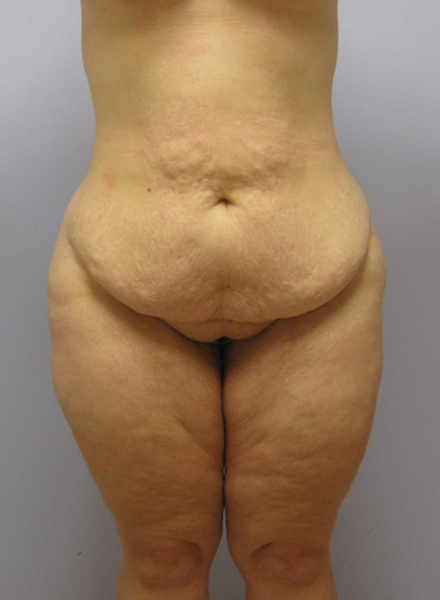 Thigh Lift Before & After Image