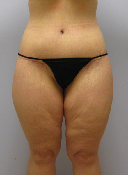 Thigh Lift Before & After Image