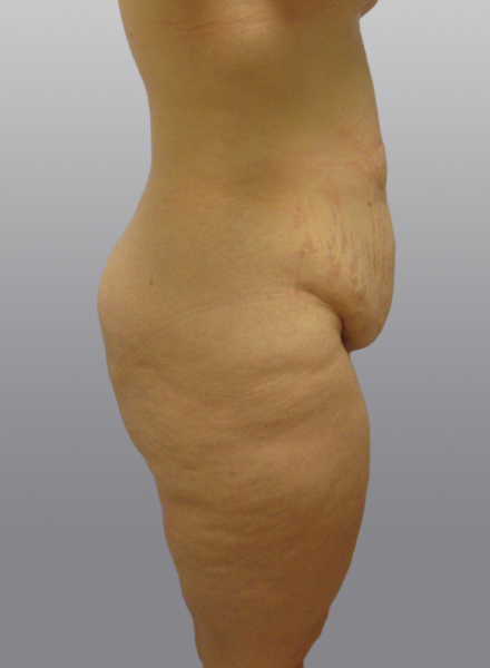 Thigh Lift Before & After Image