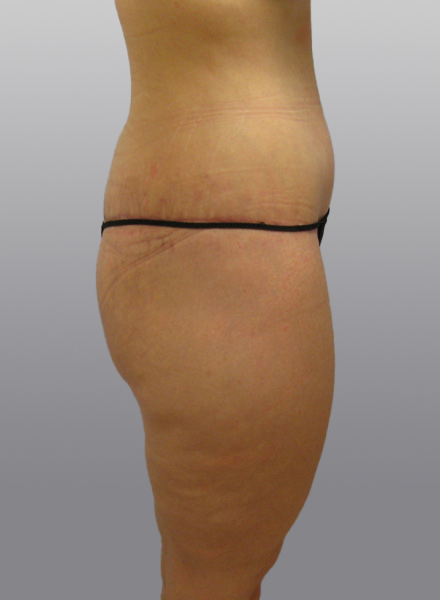 Thigh Lift Before & After Image