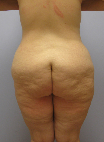 Thigh Lift Before & After Image