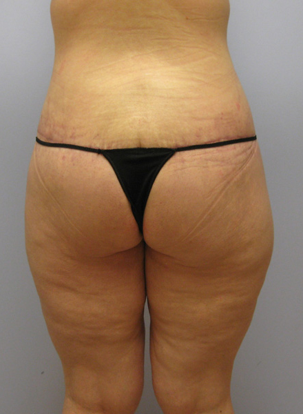 Thigh Lift Before & After Image