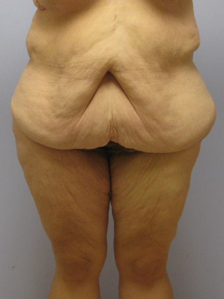 Thigh Lift Before & After Image