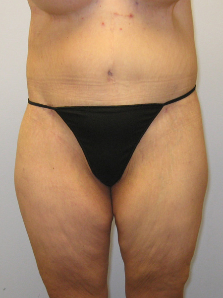 Thigh Lift Before & After Image