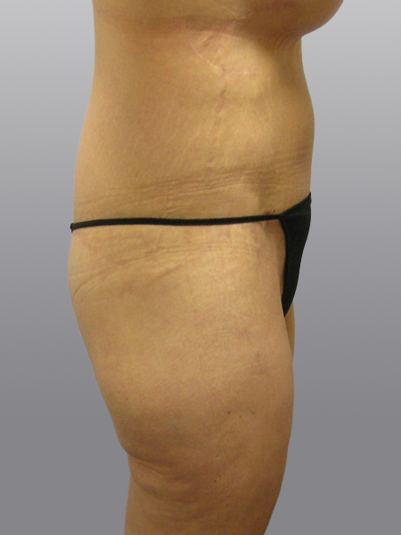 Thigh Lift Before & After Image