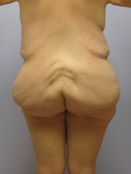 Thigh Lift Before & After Image