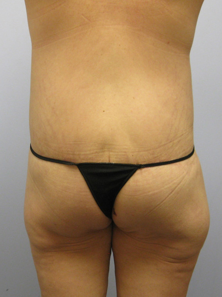 Thigh Lift Before & After Image