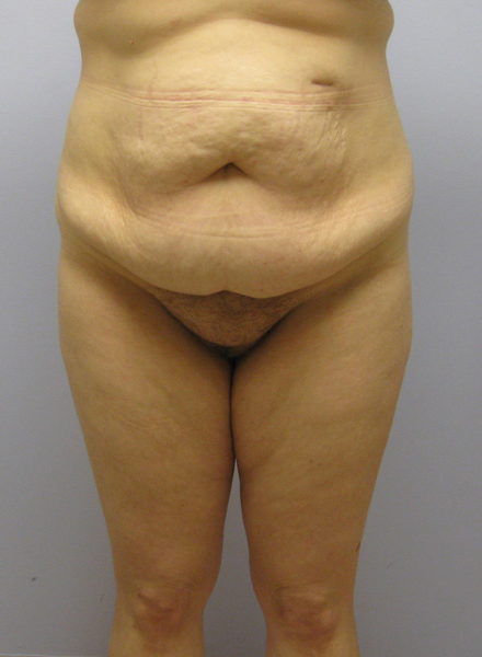 Thigh Lift Before & After Image