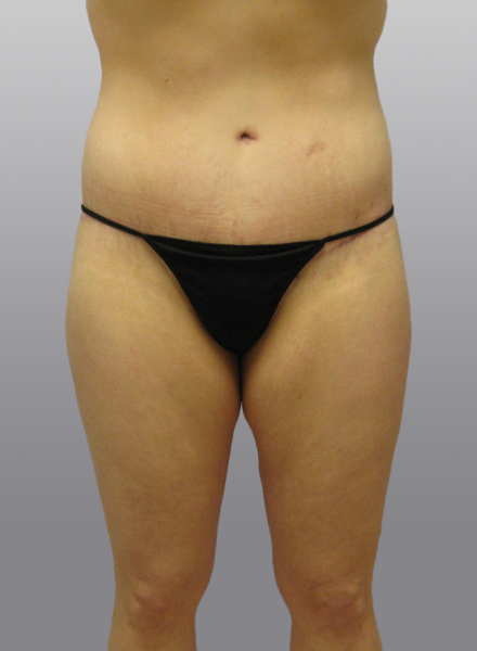 Thigh Lift Before & After Image