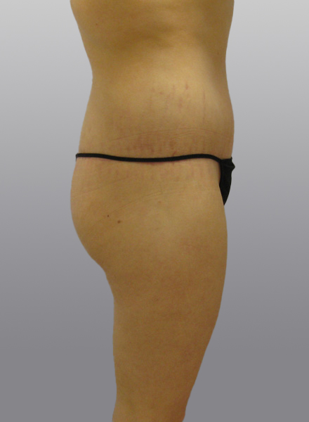 Thigh Lift Before & After Image