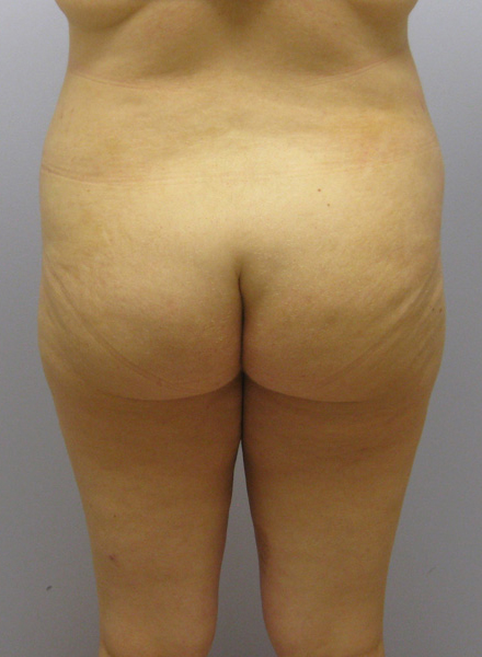 Thigh Lift Before & After Image