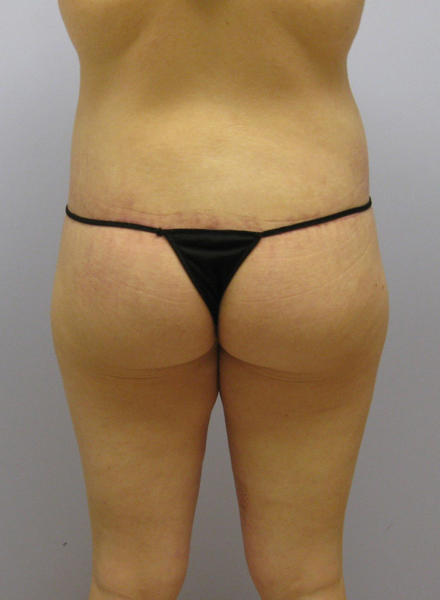 Thigh Lift Before & After Image