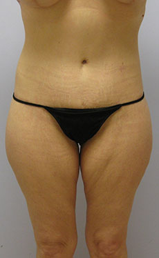 Thigh Lift Before & After Image