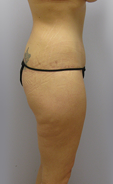 Thigh Lift Before & After Image