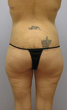 Thigh Lift Before & After Image