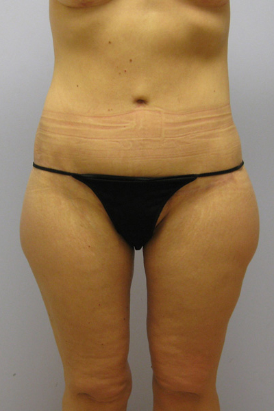 Thigh Lift Before & After Image