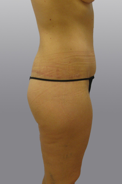 Thigh Lift Before & After Image