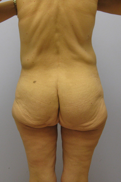 Thigh Lift Before & After Image