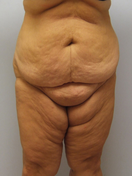 Thigh Lift Before & After Image