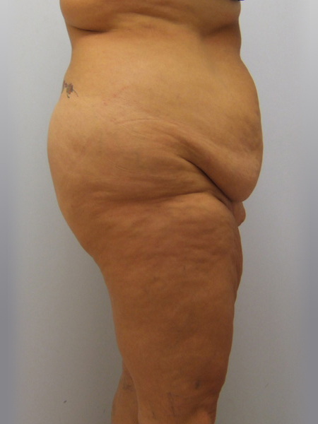 Thigh Lift Before & After Image