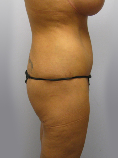 Thigh Lift Before & After Image