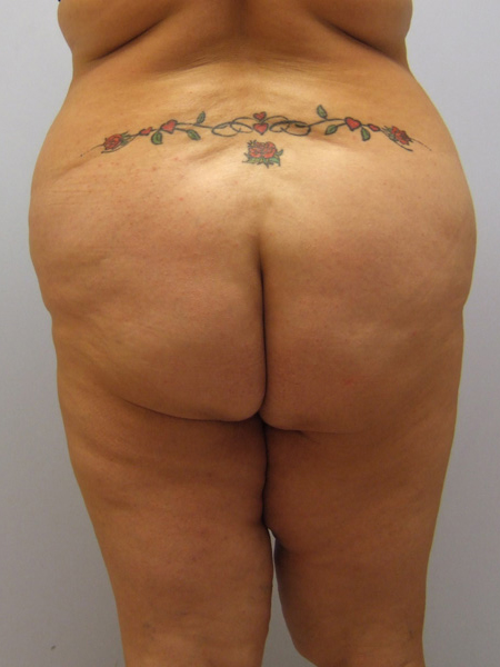 Thigh Lift Before & After Image