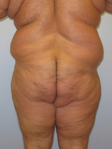 Thigh Lift Before & After Image