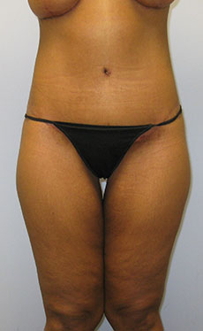 Thigh Lift Before & After Image