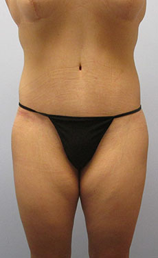 Thigh Lift Before & After Image