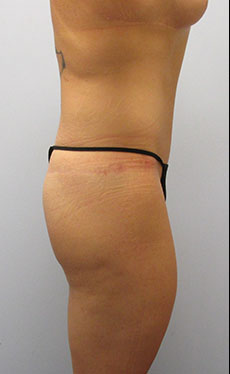 Thigh Lift Before & After Image