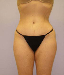 Tummy Tuck Before & After Image