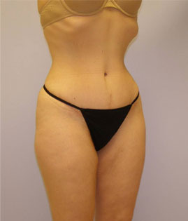 Tummy Tuck Before & After Image