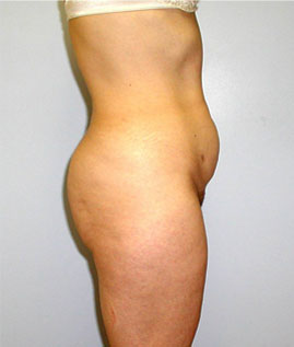 Tummy Tuck Before & After Image