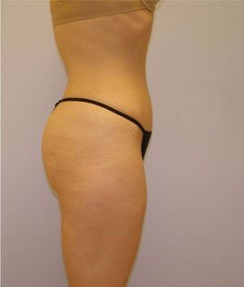 Tummy Tuck Before & After Image