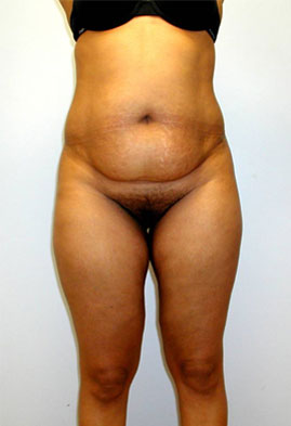 Tummy Tuck Before & After Image