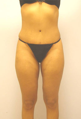 Tummy Tuck Before & After Image