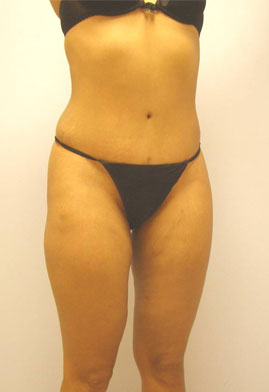 Tummy Tuck Before & After Image