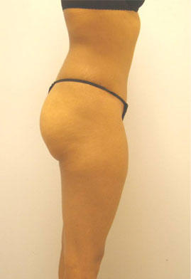 Tummy Tuck Before & After Image