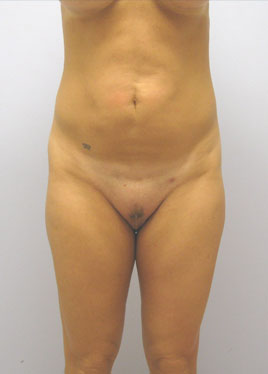 Tummy Tuck Before & After Image