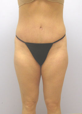 Tummy Tuck Before & After Image