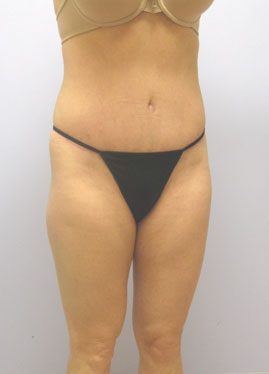 Tummy Tuck Before & After Image