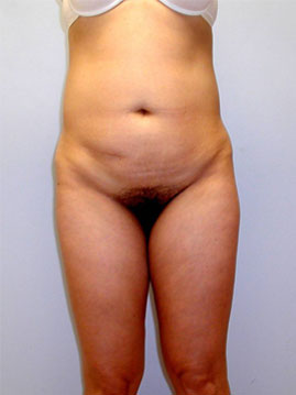 Tummy Tuck Before & After Image